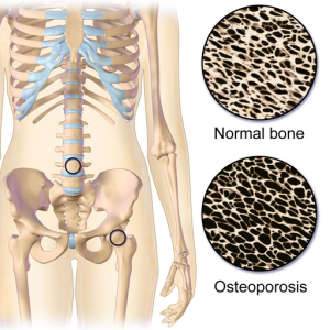 Diagram showing healthy bone density and osteoporosis