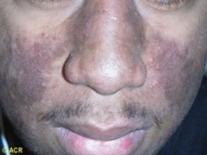 skin condition on face