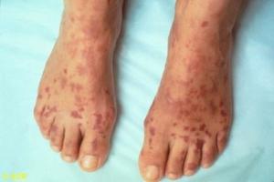 Skin condition on feet