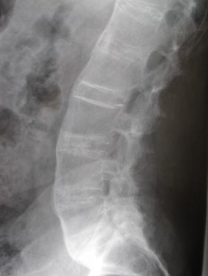 Fused spine in person with AS