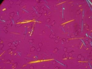 Uric acid crystals in joint fluid.