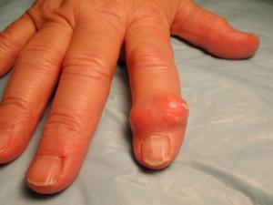 Tophus on a finger