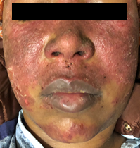 Lupus presentation on skin