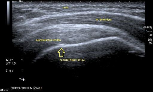 Musculoskeletal ultrasound