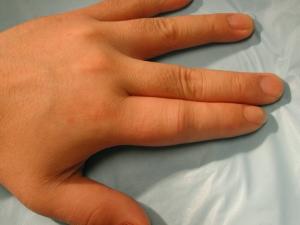 Psoriatic arthritis