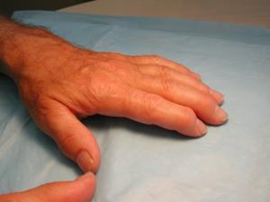 Psoriatic arthritis