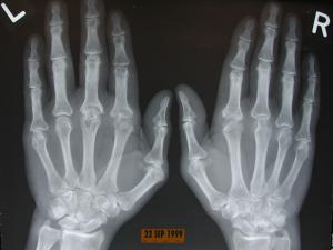 x ray of hands with rheumatoid arthritis 