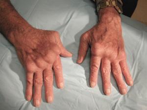 Hands with rheumatoid arthritis