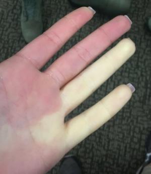 Raynaud’s phenomenon in a young woman showing blanching phase