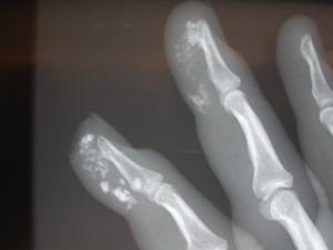 Patient with calcinosis or calcium deposition in the tissues.