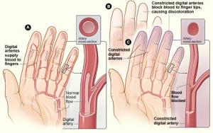 Illustration of the blood vessel constriction that happens in Raynaud's phenomenon.