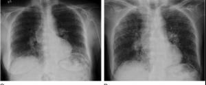 CT scan of the lungs showing fibrosis of the lungs with so called honeycombing