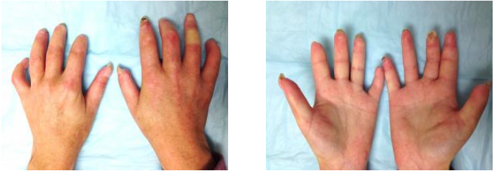 Patient with diffuse scleroderma with skin tightening and shortening of the fingers due to severs Raynaud's phenomenon.