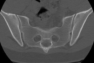 Normal CT scan of the SI joints