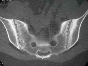 CT scan in sacroilitis