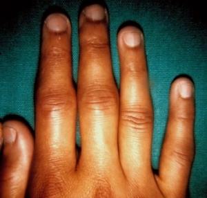 Lupus' effects on joints